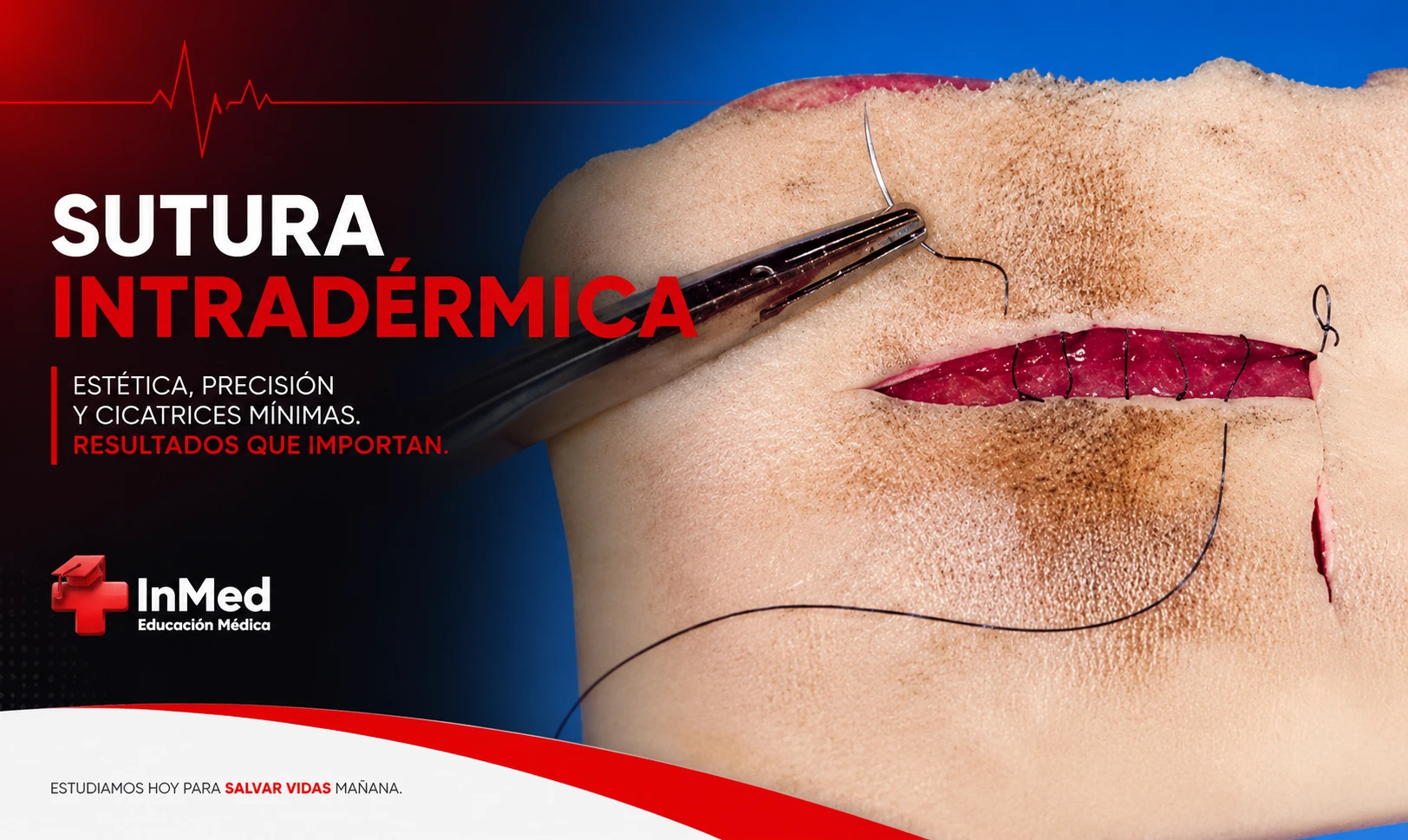 Sutura intradérmica: guía para estudiantes